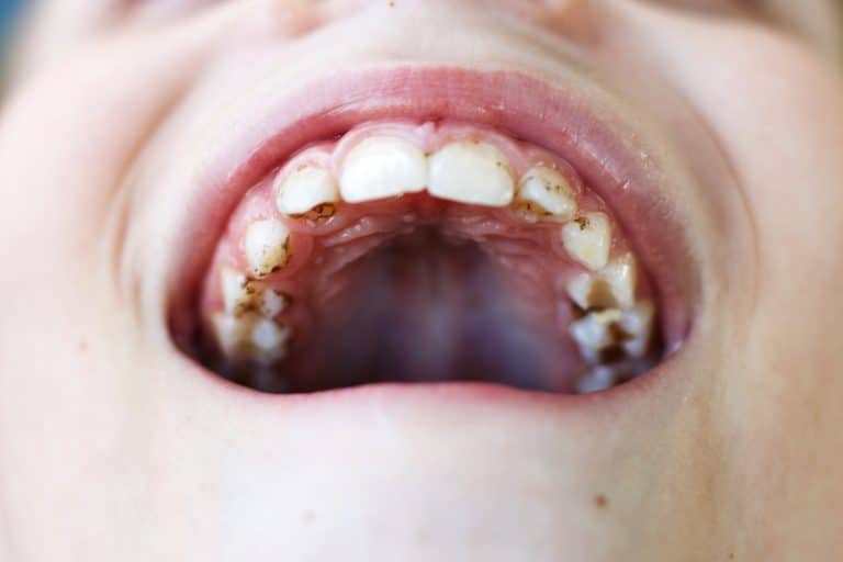 Quelle est la différence entre la plaque dentaire et le tartre ?